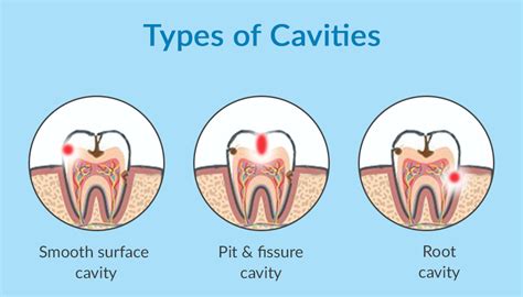 8 Myths About Cavities Explained | Pediatric Dentist Harrisburg NC