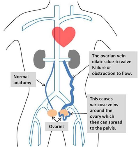 Pelvic Venous Congestion Syndrome – Interventional Radiology