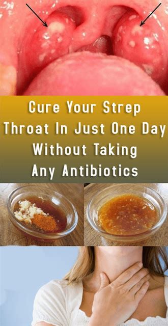 Treat Your Painful Strep Throat In Only One Day, Without Needing To Take Antibiotics | Wellness Digi