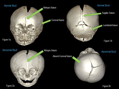 Craniosynostosis: Causes, Symptoms, Diagnosis And Treatment, 55% OFF