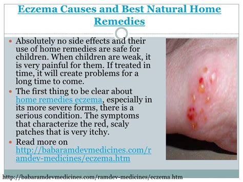 Eczema causes and best natural home remedies