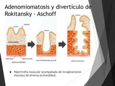 Rokitansky Aschoff Sinuses Gallbladder - Wall Changes - Sonographic ...