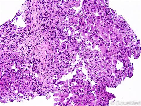 Minimally Invasive Adenocarcinoma of Lung