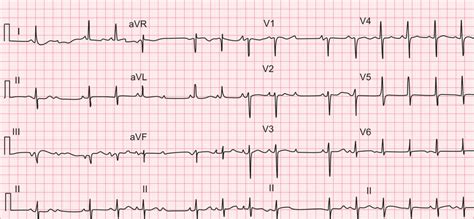 Mobitz type II second-degree AV block. Intermittently P wave fails to... | Download Scientific ...