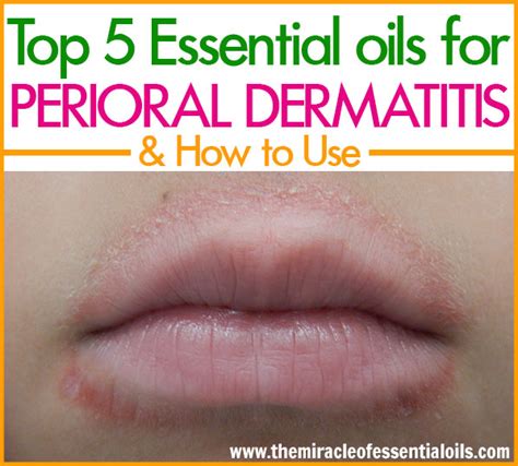 Top 5 Essential Oils for Perioral Dermatitis - The Miracle of Essential Oils