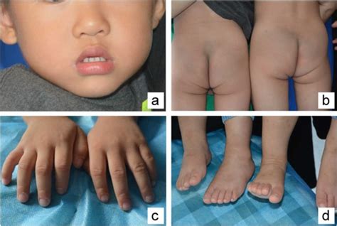 Acrodermatitis enteropathica causes, symptoms, diagnosis & treatment