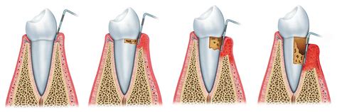 What are the Stages of Periodontal Disease? - IMPLANT PERIO CENTER