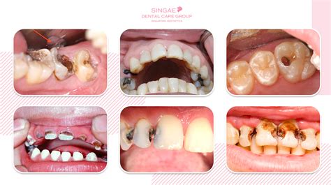 Sâu Răng - Nha Khoa Singae Dental - Singae Dental Care Group