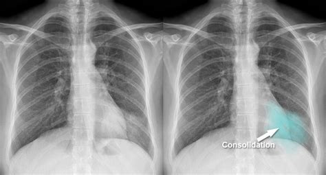 Pneumonia Chest X Ray Vs Normal - vrogue.co