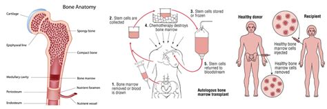 autologous bone marrow transplants clipart 10 free Cliparts | Download images on Clipground 2024