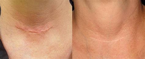 Microneedling Before & After Results | Impressions MediSpa