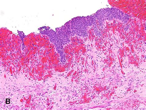 American Urological Association - Hemorrhagic Cystitis