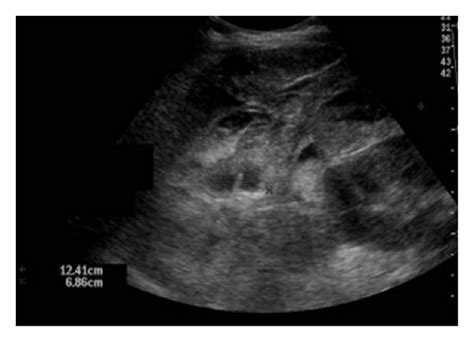 Hematoma. Longitudinal ultrasound image demonstrating a complex ...