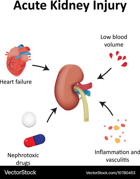 Acute kidney injury diagram renal Royalty Free Vector Image