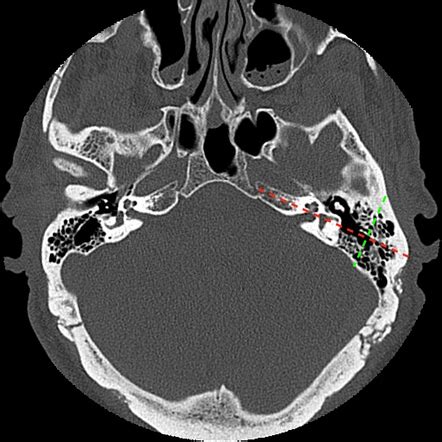 Normal petrous temporal bone CT | Image | Radiopaedia.org