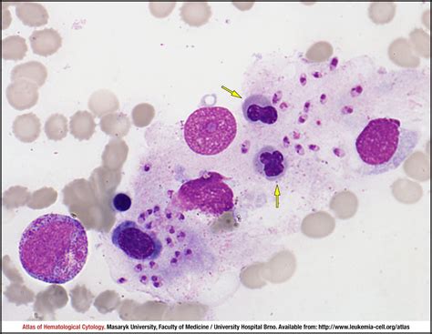 Visceral leishmaniasis - CELL - Atlas of Haematological Cytology