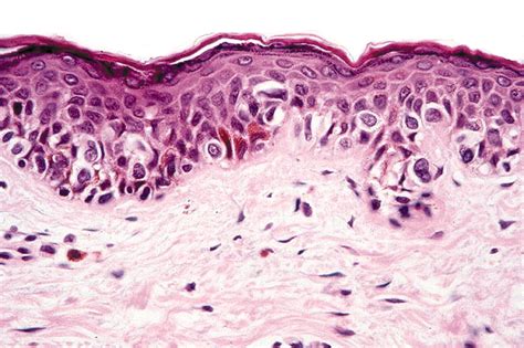 My approach to atypical melanocytic lesions | Journal of Clinical Pathology