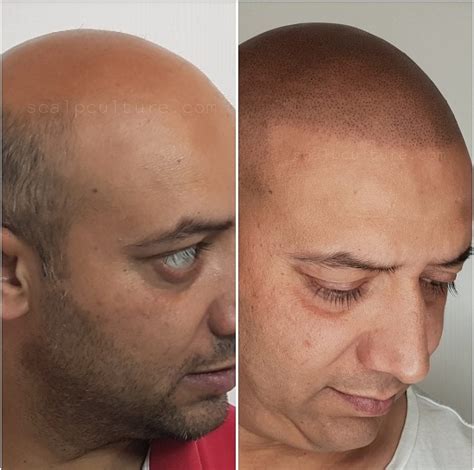 Scalp Micropigmentation Before and After | Scalp Culture