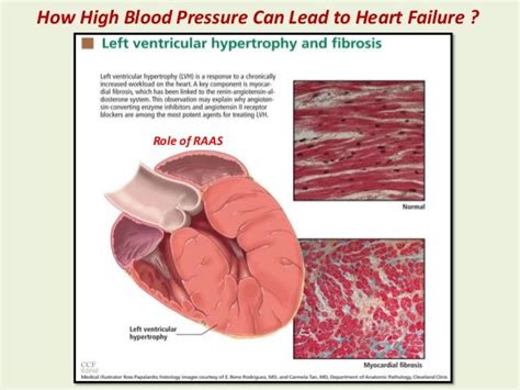 Hypertensive Heart Disease Causes Of | carfare.me 2019-2020