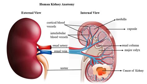 Diagram showing human kidney anatomy and Renal cell carcinoma developed... | Download Scientific ...