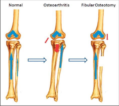 Figure 6 from Proximal fibular osteotomy: a new surgery for pain relief and improvement of joint ...