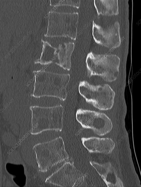 Secondary bone cancer in the spine, CT scan - Stock Image - C033/7534 - Science Photo Library