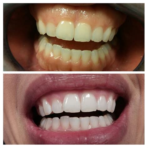 Pin on Teeth Whitening