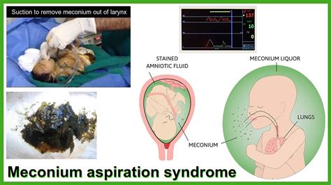 meconium aspiration syndrome - YouTube