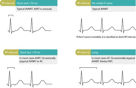 Figure x. Differential diagnoses based on RP interval. – ECG learning