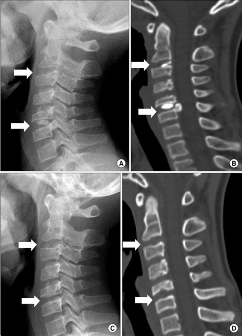 What Is Intervertebral Disc Syndrome