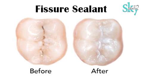 Dental sealants - Procedure, Uses, Drawbacks, & Treatment