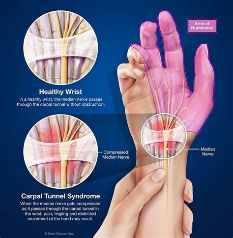 Carpal Tunnel Syndrome | Sports Chiropractor In Guilderland, NY