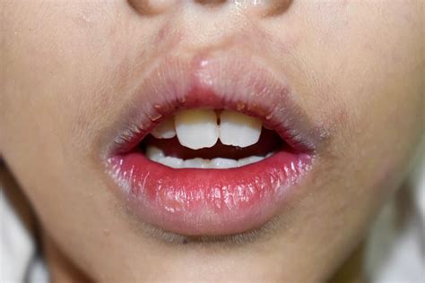 Eczema On Lips Uk | Lipstutorial.org