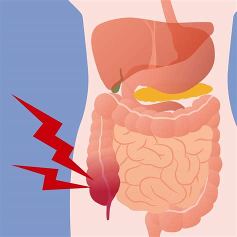 Qu’est-ce qu’une appendicite? Clinique à Montréal