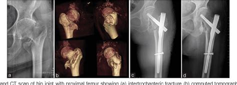 Figure 1 from PFNA-II protrusion over the greater trochanter in the Asian population used in ...