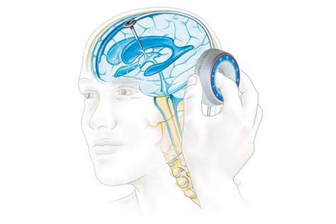 Understanding Hydrocephalus