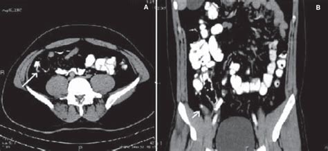 (A, B): Distal appendicitis. Contrast-enhanced axial CT scan (A) shows... | Download Scientific ...