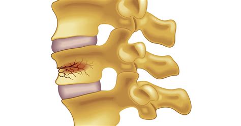 Compression Fractures of the Spine | Scottsdale, AZ Orthopedic Spine Surgery