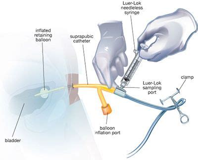 Urinary Catheter Care | Urinary catheterization, Catheter, Medical ...