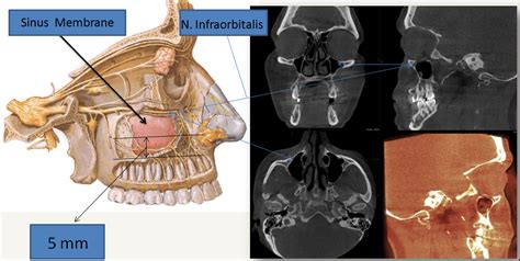 Sinus Cysts In Humans