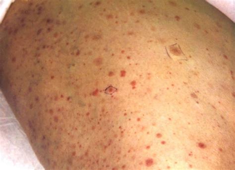 Petechiae definition, petechial rash causes, diagnosis & treatment