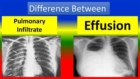 Difference between Pulmonary Infiltrate and Effusion - YouTube