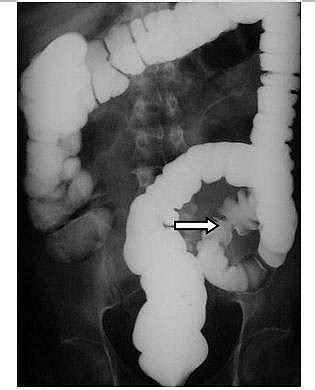 Single and Double Contrast Barium Enema Procedure: Indications and side effects - Jotscroll