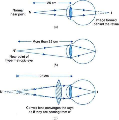 Make a diagram to show how hypermetropia is corrected . The near point of hypermetropia eye is ...