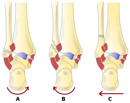 Danis-Weber Classification of Ankle Fractures - Physiopedia