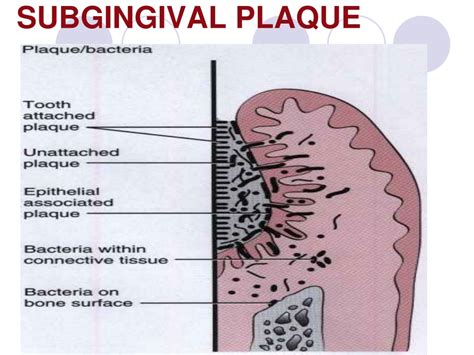 PPT - DENTAL PLAQUE PowerPoint Presentation, free download - ID:9511546