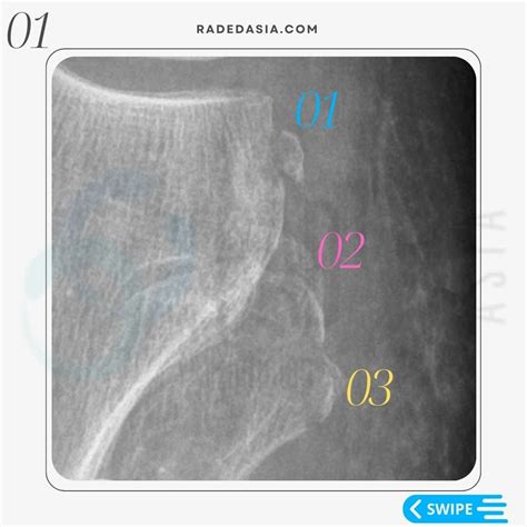 3 LATERAL KNEE FRACTURES SEGOND ARCUATE AND LATERAL FIBULAR FRACTURES XRAY - Radedasia