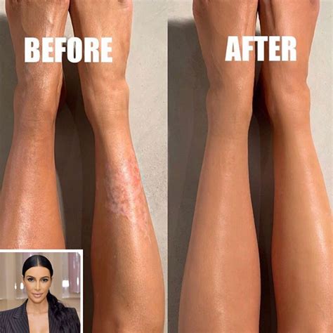 Kim Kardashian Covers Up Her Psoriasis Using New KKW Beauty Body Makeup ...