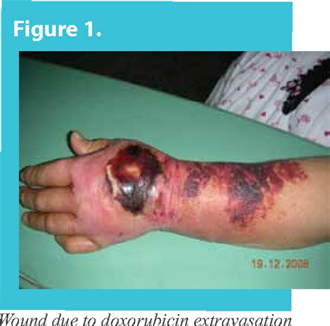 Figure 2 from Vesicant extravasation due to doxorubicin administration ...