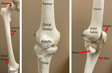 Distal Femur Fracture Classification